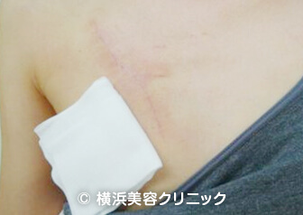 胸の刺青・タトゥー除去症例写真