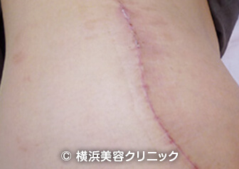 腰部分の刺青・タトゥー除去症例写真
