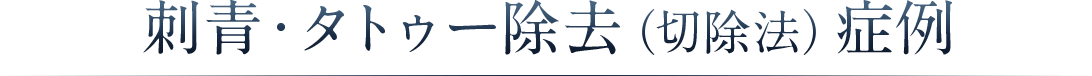 刺青・タトゥー除去（切除法）症例