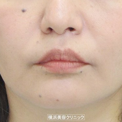 人中短縮術 鼻下短縮術／リップリフト　症例1