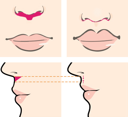 鼻下短縮術（人中短縮術）の術前と術後の切開線