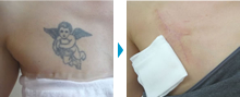 身体（刺青除去・脂肪吸引など）の部分モニター症例写真