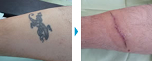 身体（刺青除去・脂肪吸引など）の部分モニター症例写真