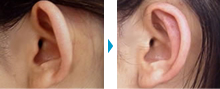 顔（頬・口・耳・顎など）の部分モニター症例写真