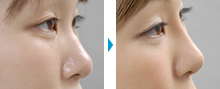 鼻の部分モニター症例写真