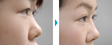 鼻の部分モニター症例写真