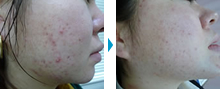 皮膚科（ニキビ・ホクロ・シミ治療など）の部分モニター症例写真