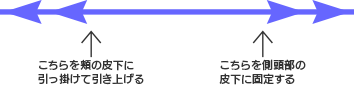 こちらを側頭部の皮下に固定する・こちらを頬の皮下に引っ掛けて引き上げる