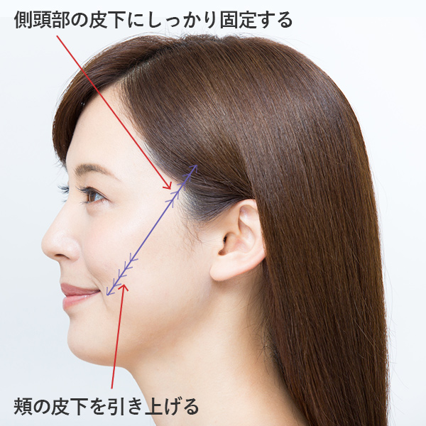 側頭部の皮下にしっかり固定する・頬の皮下を引き上げる