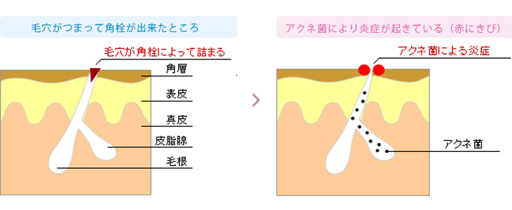 ニキビ（にきび）の原因