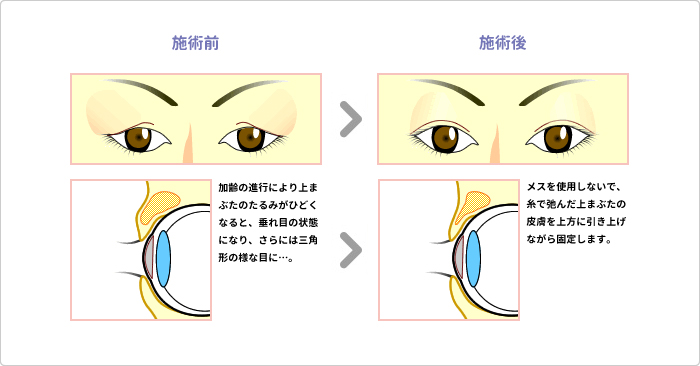 切らないアイリフト（上まぶた） 説明図1