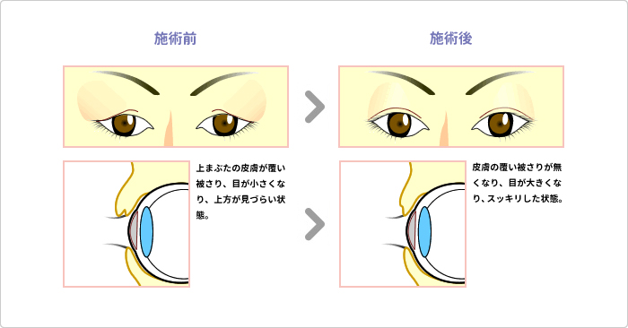 上まぶたのたるみ取り 説明図