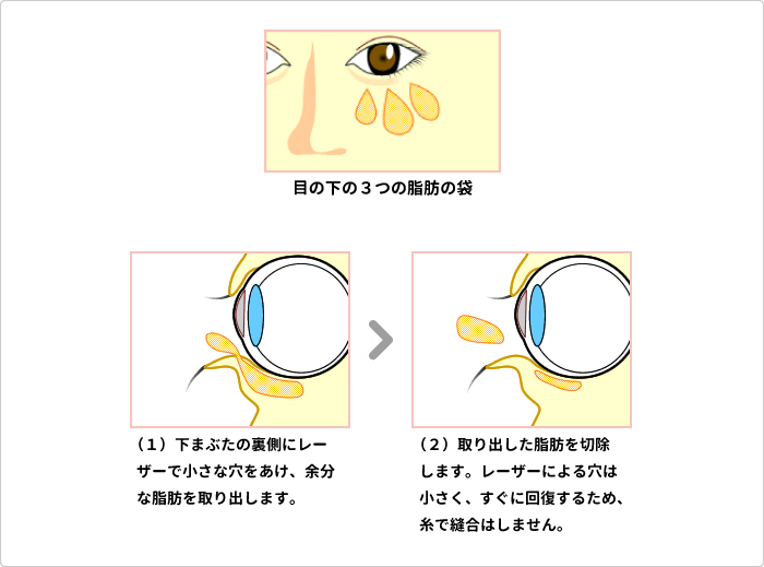 目の下のたるみ取り＋脱脂 説明図