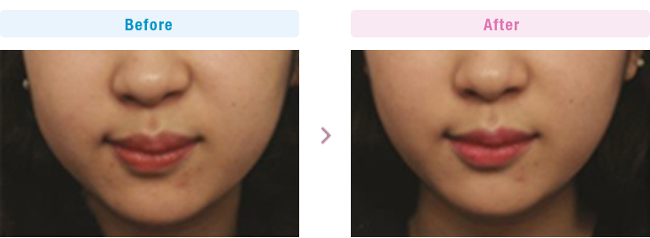 小顔注射（BNLS）の症例