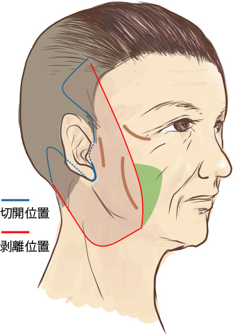 フェイスリフト症例解説
