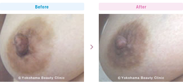 乳頭・乳輪の形成の症例