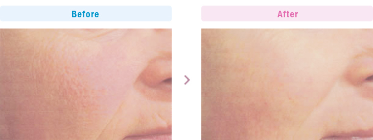 頬の肌質改善例