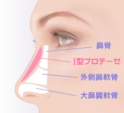 当院のプロテーゼによる隆鼻術