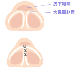 鼻尖縮小術（鼻尖形成術）