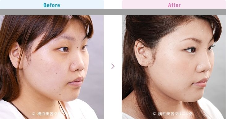 【20代女性】鼻全体を細く高くするにはＬ型プロテーゼによる隆鼻術が効果的【横浜美容クリニック】