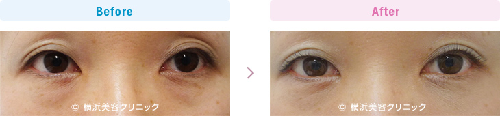 【30代女性】目の下の膨らみが減ることにより、クマっぽい印象が改善します。【横浜美容クリニック】
