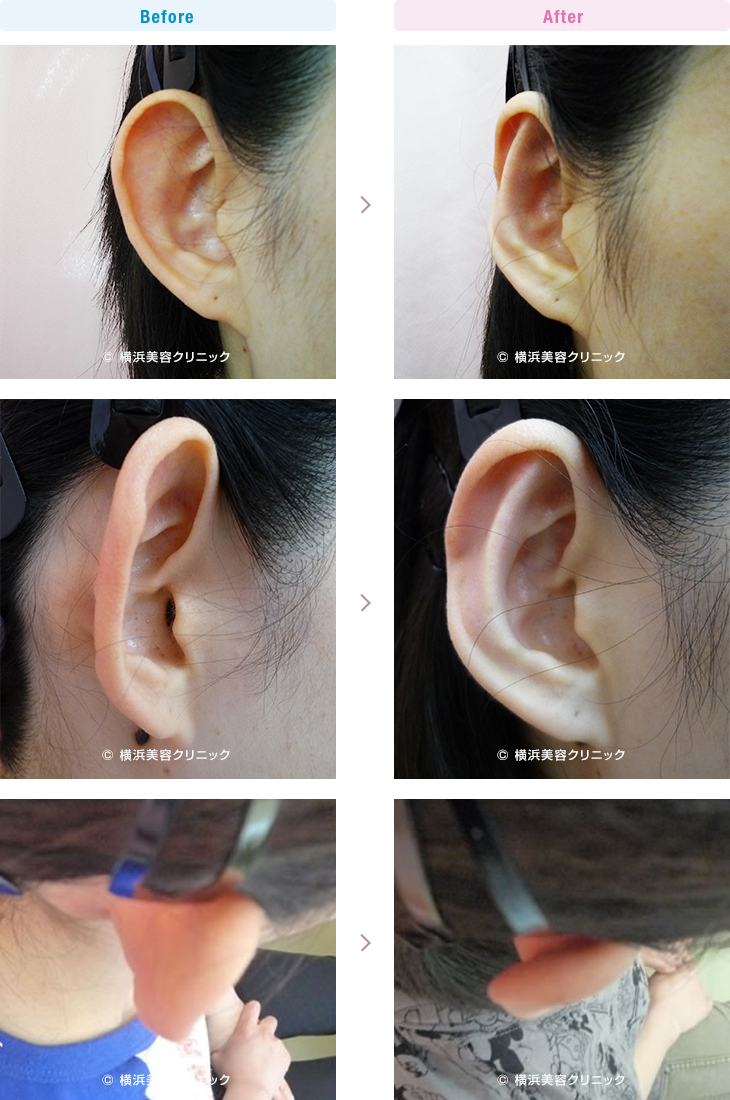 耳の美容外科・美容整形（立ち耳・耳垂裂） 【20代女性】対耳輪の折れ曲がりが無い、完全な立ち耳の方です。（立ち耳症例1）2【横浜美容クリニック】