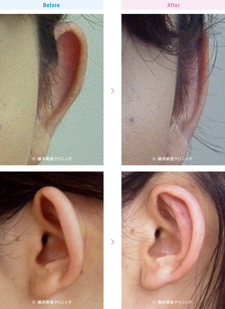 耳の美容外科・美容整形（立ち耳・耳垂裂） 【20代女性】当院の立ち耳形成は、元に戻りにくいです。【横浜美容クリニック】