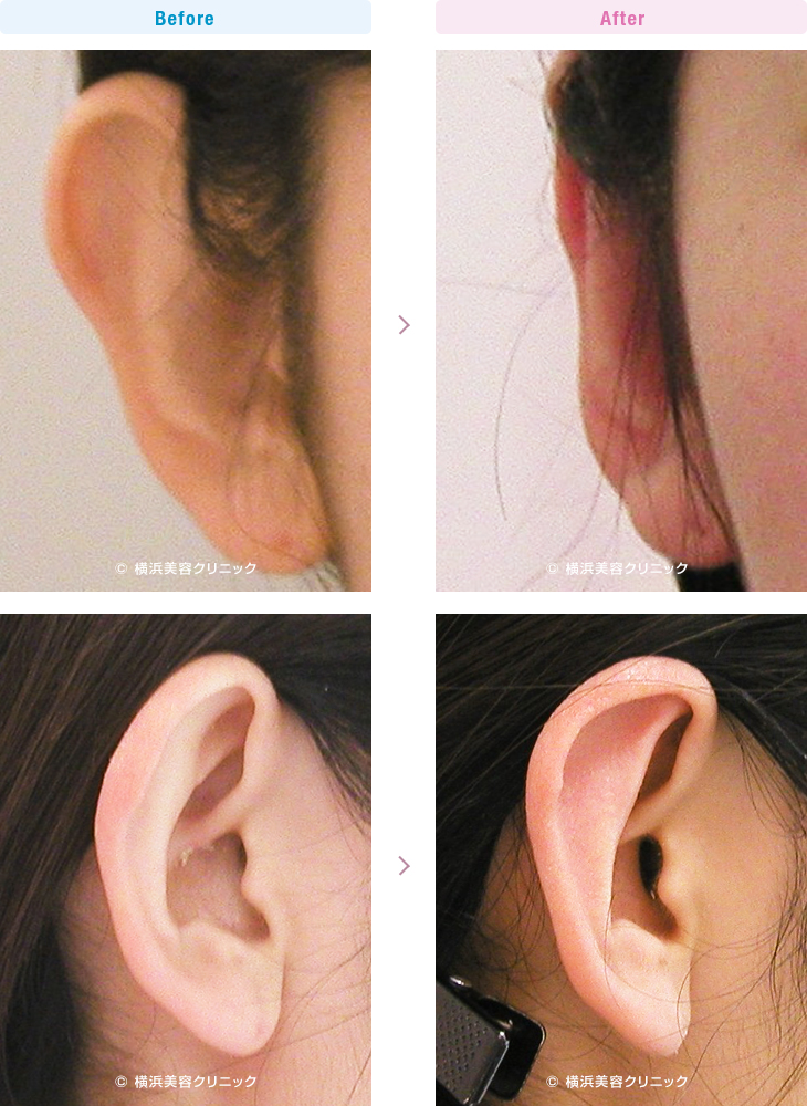 耳の美容外科・美容整形（立ち耳・耳垂裂） 【30代女性】耳が正面を向いている立ち耳には、立ち耳形成が有効です。【横浜美容クリニック】