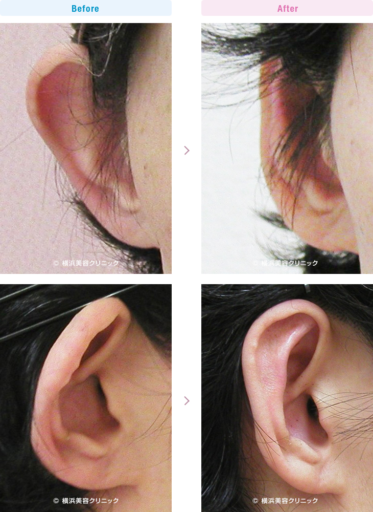 耳の美容外科・美容整形（立ち耳・耳垂裂） 【30代女性】耳が大きく見える悩みには、立ち耳形成が有効です。【横浜美容クリニック】