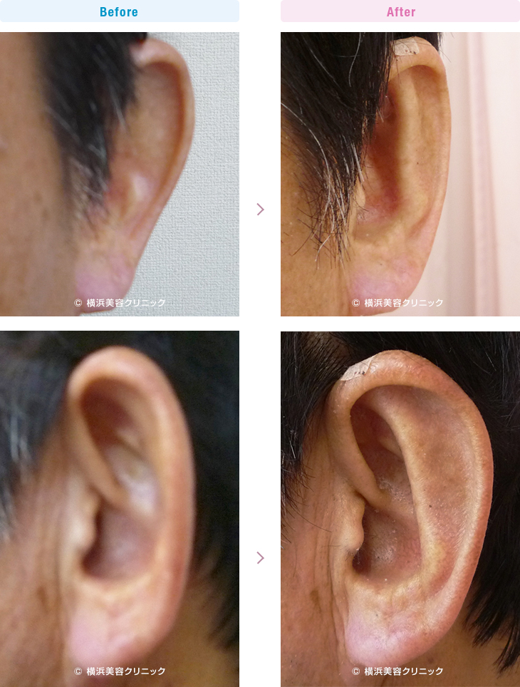 男性美容 完全な立ち耳の症例です。（立ち耳）2【横浜美容クリニック】