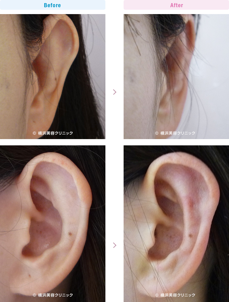 耳の美容外科・美容整形（立ち耳・耳垂裂） 【30代女性】上部だけの軽度な立ち耳も、立ち耳形成で簡単に改善することが可能です。【横浜美容クリニック】