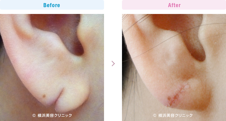 耳の美容外科・美容整形（立ち耳・耳垂裂） 【20代女性】ピアスによって裂けてしまった耳たぶ（耳垂裂）は、耳垂裂形成で簡単に治すことが可能です。【横浜美容クリニック】