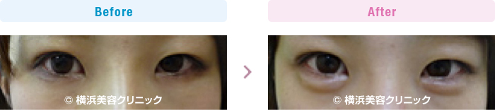 【20代女性】 ヒアルロン酸注入により涙袋を作りました (目袋形成)