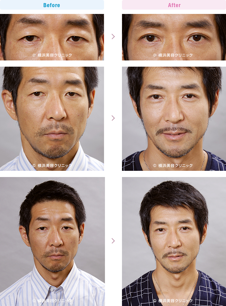 目の施術（二重・涙袋など） 【40代男性】重たい腫れまぶたの場合は、脂肪を取って３点で留める部分切開法がお勧め【横浜美容クリニック】