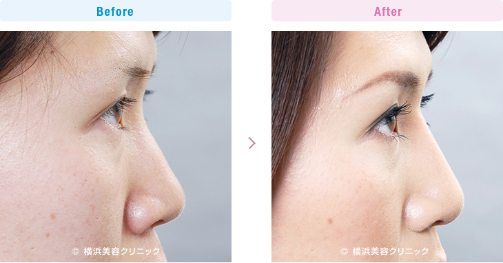 【20代女性】鼻筋を通して鼻の穴も目立たなくしたい場合は、隆鼻術＋小鼻縮小の複合手術が効果的【横浜美容クリニック】
