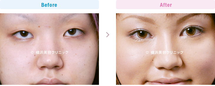 【20代女性】目と目の間が離れて見える場合、目頭切開だけでなく隆鼻術も有効です。
