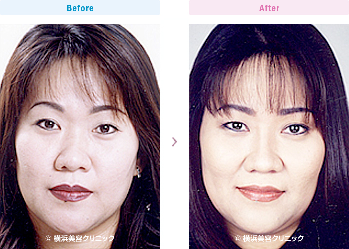 【30代女性】鼻先まで含めて鼻全体を高くするにはＬ型プロテーゼによる隆鼻術が適応になります。【横浜美容クリニック】