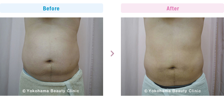 男性美容 お腹上下と腰に６本（６０ｃｃ）、２週間間隔で５回行いました。（脂肪溶解注射）2【横浜美容クリニック】