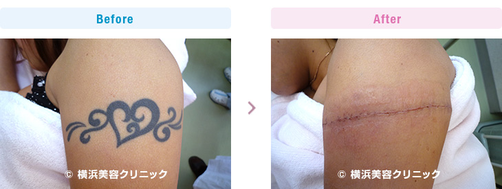 刺青・タトゥーの除去（切除法）横軸切開ですが、刺青の幅が小さいので１回の手術で取り除くことが出来ました。（腕部分）【横浜美容クリニック】