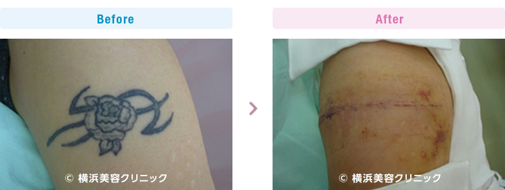 刺青・タトゥーの除去（切除法）横軸切開で、１回の手術で完全に取り除くことが出来ました。（腕部分）【横浜美容クリニック】