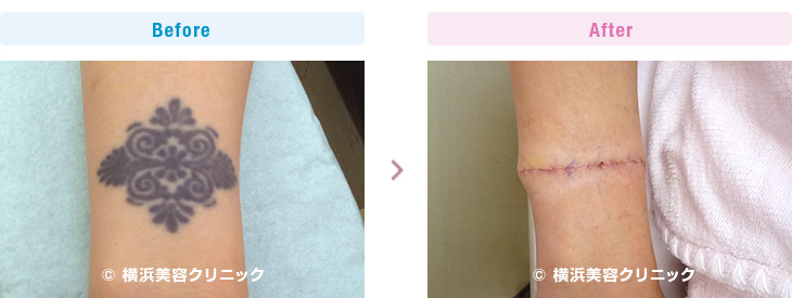 手首の刺青切除は手指への血行に注意して行わなければなりません。（手・手首・前腕部分）【横浜美容クリニック】