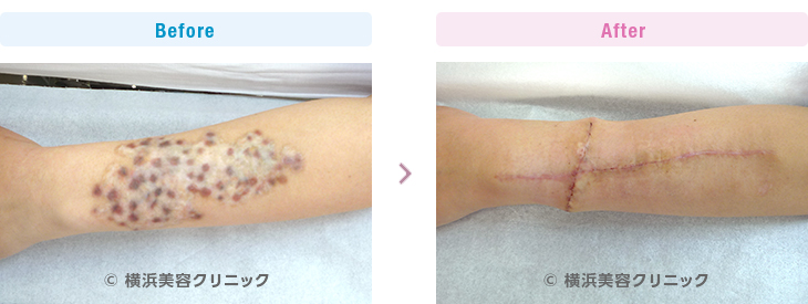 他院にてタトゥアウェイという刺青を消す器械の治療を受けた跡です。（手・手首・前腕部分）【横浜美容クリニック】