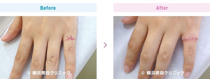 刺青・タトゥーの除去（切除法）指のリング状刺青切除例です。（手・手首・前腕部分）【横浜美容クリニック】
