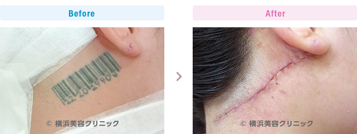 刺青・タトゥーの除去（切除法）耳後部の刺青です。（女性・首部分）【横浜美容クリニック】