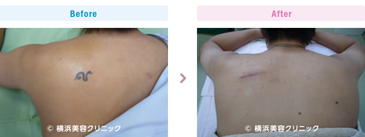 刺青・タトゥーの除去（切除法）１回の手術で取り除きました。（背中部分）【横浜美容クリニック】