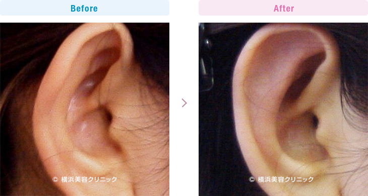 裂けてしまった耳たぶ 裂け耳 耳切れ 切れ耳 は病院で治療を 神奈川県の美容整形 美容外科 横浜美容クリニック