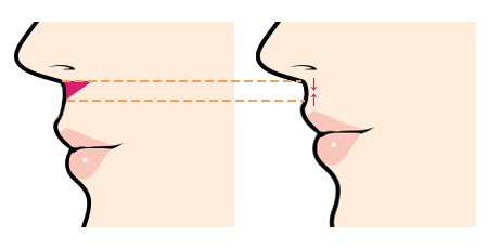 人中短縮術（リップリフト、鼻下短縮術）