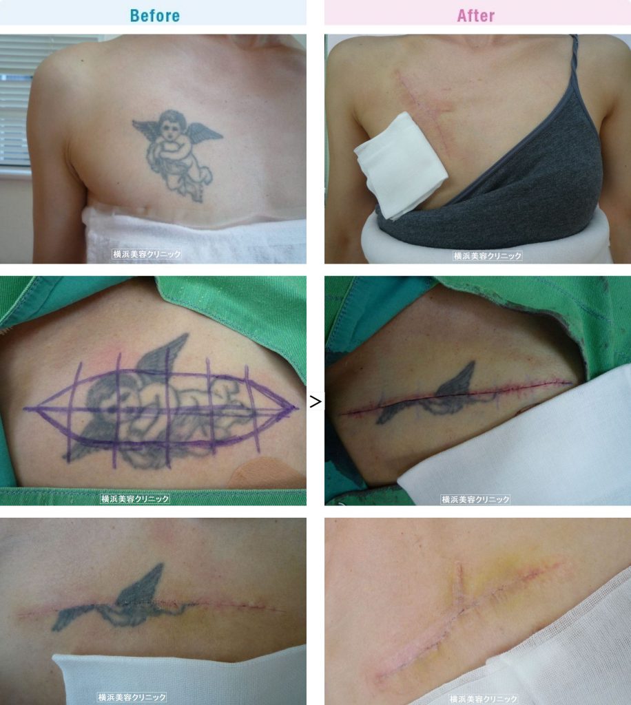 刺青・タトゥーの除去（切除法）２回に分割して切除しました。（女性・胸部分）【横浜美容クリニック】