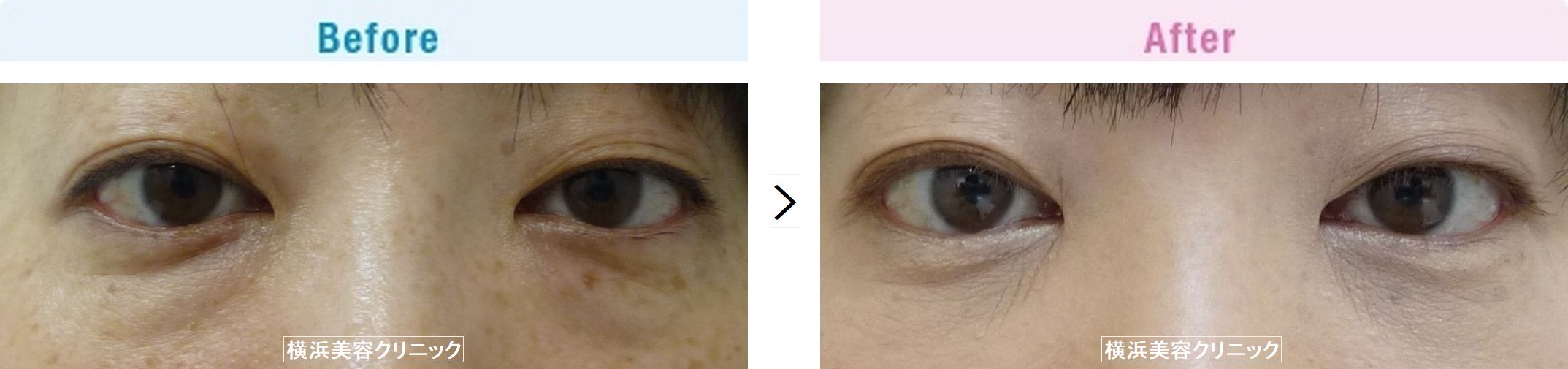 【30代女性】切らない目の下の脂肪取り（くま取り）で目の下の膨らみが減ることにより、疲れた印象が改善します。【横浜美容クリニック】