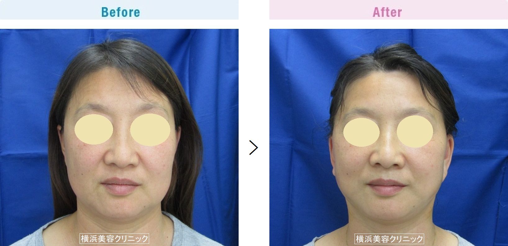 【50代女性】タルミによる四角いフェイスラインを小顔効果があるフェイスリフト（切開リフト）でスッキリと改善。【横浜美容クリニック】